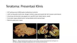 Mediastinal Germ Cell Tumor [upl. by Nehemiah400]