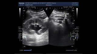 Ultrasound Video showing two cases of stone in ureter [upl. by Annaehr21]