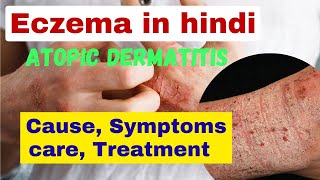 eczema kya hota hai  atopic dermatitis in hindi  skin problem  eczema treatment [upl. by Nauqyt]