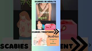 How to treat Scabies scabies treatmentplan health skincare youtubeshorts shortvideo viral [upl. by Kho12]