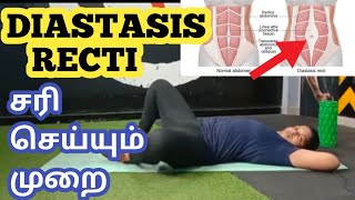 Diastasis Recti  How to Test பிரசவத்திற்குப் பிறகு வரும் தொப்பையை சரிசெய்யும் முறை [upl. by Hartmunn893]