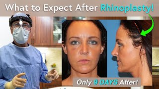 What Can I Expect During Rhinoplasty Recovery One Day to Three Weeks PostOp [upl. by Lareneg]