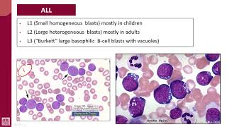 Hematology  2  U2L31  FAB classification of ALL subtypes  1 [upl. by Major]