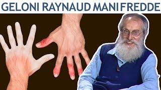 Dott Mozzi Geloni fenomeno di Raynaud mani e piedi freddi [upl. by Adnael]