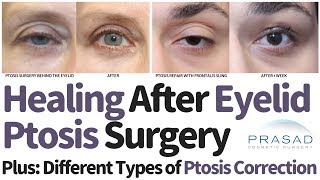 Different Types of Eyelid Ptosis Surgical Correction Techniques and Expected Healing Time [upl. by Nike]