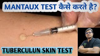 Mantoux test  TST  PPD  Tuberculin skin test  Diagnosis of TB [upl. by Galen889]