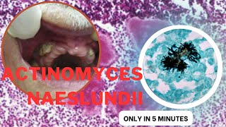 actinomyces microbiology lecture actinomyces naeslundii Easy Microbiology [upl. by Muffin]