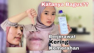 Review Hatomugi Skin Conditioner Bagus Untuk Jerawat Tapi Malah Jerawatan 😱😱😱😱 [upl. by Pantheas804]