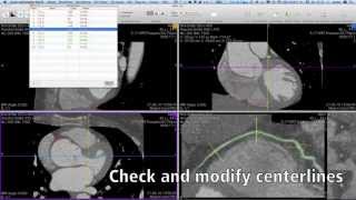 Cardiac CTA with OsiriX PRO [upl. by Bilac367]