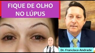 Problemas nos olhos de quem tem Lúpus Eritematoso Sistêmico [upl. by Marcos675]