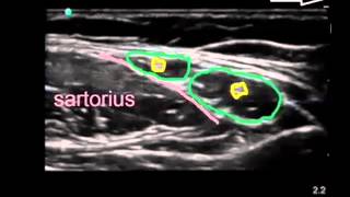 lateral femoral cutaneous nerve [upl. by Ykceb835]