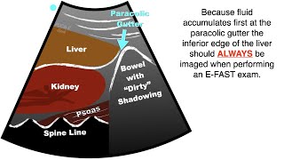 POCUS EFAST  Progression free fluid in the Right Upper Quadrant RUQ [upl. by Aihsak]