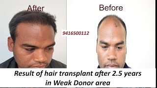 Result of hair transplant in weak donor area after 25 Years  Dr Navdeep Hair Transplant Clinic [upl. by Aniara]