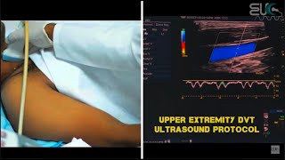 Upper Extremity DVT Ultrasound Protocol [upl. by Abbate]