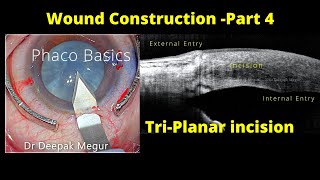 Phaco Basics Incisions Part4 Understanding TriPlanar  Bi Planar amp Mono Planar IncisionsDR MEGUR [upl. by Githens]