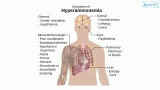 hyperammonemia [upl. by Lehacim]