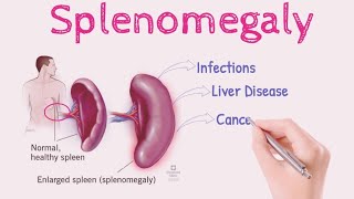 Splenomegaly OR Enlarged Spleen  Sign and Symptoms  Causes  Risk Factors  Treatment [upl. by Nolad166]