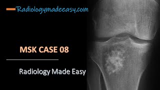 FRCR Radiology MSK case 08  A 25 year old patient presented with knee joint pain [upl. by Haela285]