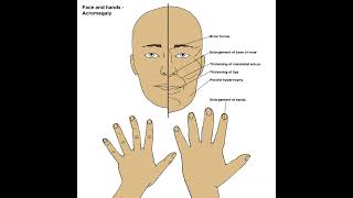 Acromegaly definition amp Meaning Health Healthcare Healthtips [upl. by Asilem358]