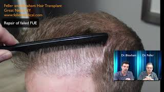 FUE repair by Dr Bloxham  Feller and Bloxham Hair Transplant NY NJ  CT  PA  FL [upl. by Onairotciv]