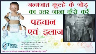 Congenital Hip Dislocation जन्मजात कूल्हे के जोड़ का उतर जाना पहचान एवं इलाज Dr J K Jain [upl. by Ellenahs524]