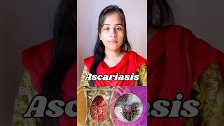 Ascariasis  protozoan disease🦠causes symptoms  transmission ascaris neet biology shortvideo [upl. by Joya]