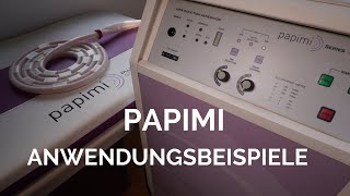 papimi Ionen Induktions Therapie  Behandlungsbeispiele [upl. by Sascha]