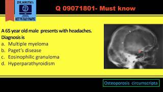 Lytic lesions of skull Differentials [upl. by Rotman]