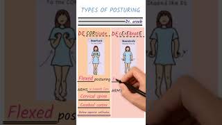 Decorticate vs Decerebrate posture [upl. by Marelda]