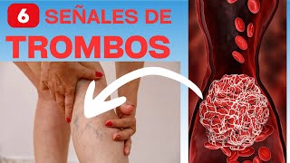 6 señales de que tendrás trombosis o coágulos [upl. by Anua]