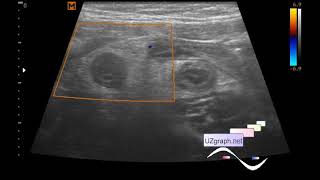 Ecografía abdominal pediátrica apendicitis flemonosa aguda omentitis [upl. by Melony]