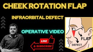 CHEEK ROTATION FLAP WITH ZPLASTY [upl. by Elmo]