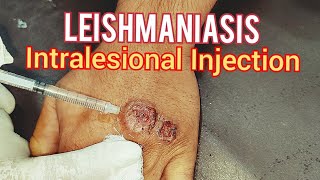 Leishmaniasis Treatment [upl. by Anivlek340]