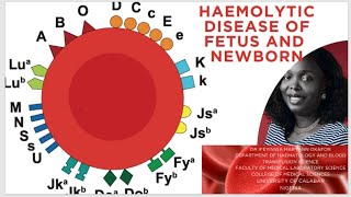 HAEMOLYTIC DISEASE OF THE FETUS AND NEWBORN hdfn hdn titration [upl. by Aserehs663]