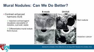 EUS of Pancreatic Cysts What’s New [upl. by Ymmot187]