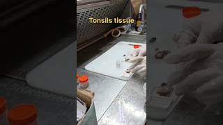 Tonsils tissue for histopathology [upl. by Letnuhs]