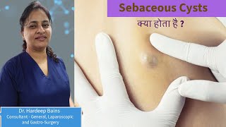 Sebaceous Cyst Removal  Surgery of Sebaceous Cyst By Dr Hardeep Bains in Delhi [upl. by Arretnahs745]