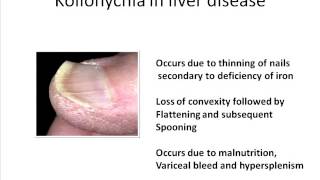 Koilonychia and Dupuytrens contracture in liver disease [upl. by Katha9]