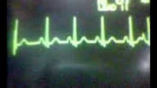 ECG Video Ectopics  Atrial [upl. by Roon]