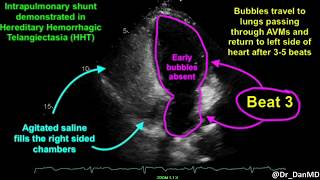 Pulmonary Arteriovenous Malformations AVMs in HHT [upl. by Tansy708]