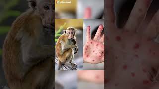 Monkeypox The New Global Health Concern  WHO Issues Warning – What You Need to Know [upl. by Krystin]