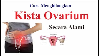 Cara Menghilangkan kista ovarium secara alami [upl. by Assilam]