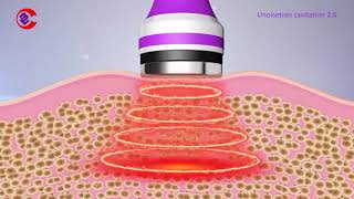 How Ultrasonic Cavitation Work How Ultrasonic Cavitation Remove Fat What Is Cavitation Machine [upl. by Hitoshi]