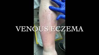 Venous Stasis Venous Eczema amp Venous Insufficiency [upl. by Nylrac]