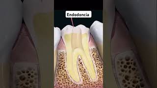 Endodoncia parati fyp endodoncia endo dolordemuela infecciondental viralfypシ [upl. by Ednil]