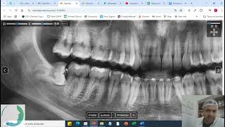 MayLuiFraCar  Exodontia dos sisos  Biomaterial [upl. by Baugh]