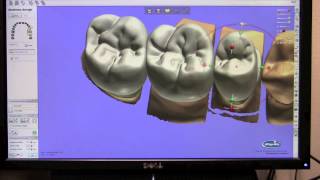 Virtual Articulation Featuring the 3Shape D700 Digital Scanner and Denar Mark 330 Articulator [upl. by Festatus]