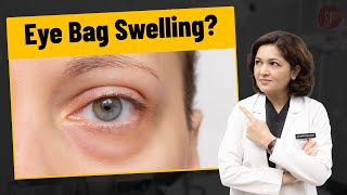 How to treat under eye swelling shorts youtubeshorts undereye swelling eyebags plasticsurgeon [upl. by Merrily]