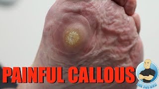 HUGE PAINFUL CALLOUS REMOVAL AND HOW TO STOP IT FROM GROWING [upl. by Walling]