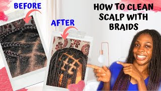 HOW TO CLEAN SCALP WITH BRAIDS WITHOUT WASHING  KNOTLESS BOX BRAIDS [upl. by Zelde]